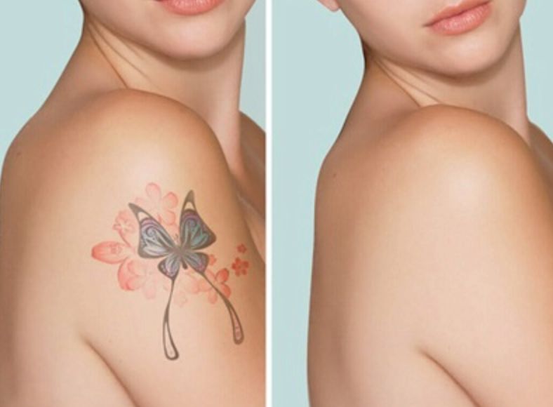 Rejuvi Tattoo Removal